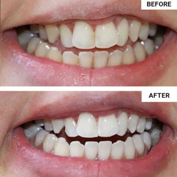 WellaWhite Electric Toothbrush user Ana K.
